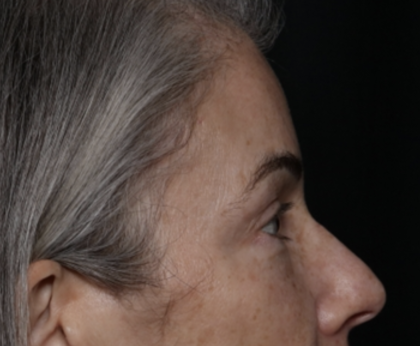 Upper Blepharoplasty Before & After Patient #35752