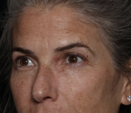 Upper Blepharoplasty Before & After Patient #35752