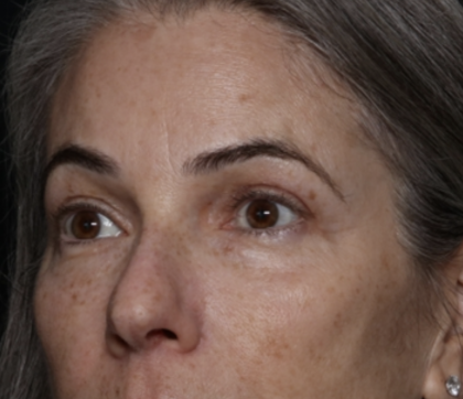 Upper Blepharoplasty Before & After Patient #35752