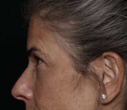 Upper Blepharoplasty Before & After Patient #35752