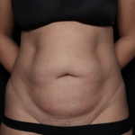 Tummy Tuck Before & After Patient #35884