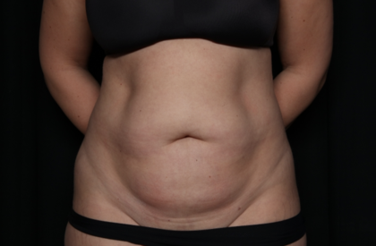 Tummy Tuck Before & After Patient #35884