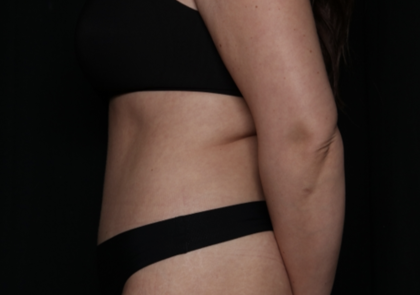 Tummy Tuck Before & After Patient #35884