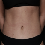 Tummy Tuck Before & After Patient #35884