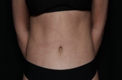Tummy Tuck Before & After Patient #35884