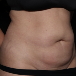 Tummy Tuck Before & After Patient #35884