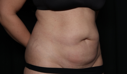 Tummy Tuck Before & After Patient #35884