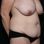 Mommy Makeover Before & After Patient #35851