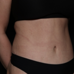 Tummy Tuck Before & After Patient #35884