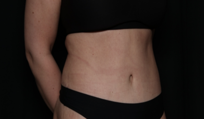 Tummy Tuck Before & After Patient #35884