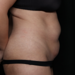 Tummy Tuck Before & After Patient #35884