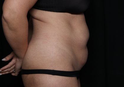 Tummy Tuck Before & After Patient #35884