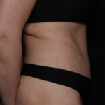 Tummy Tuck Before & After Patient #35884
