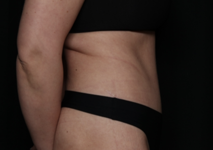 Tummy Tuck Before & After Patient #35884