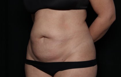 Tummy Tuck Before & After Patient #35884