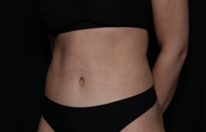 Tummy Tuck Before & After Patient #35884