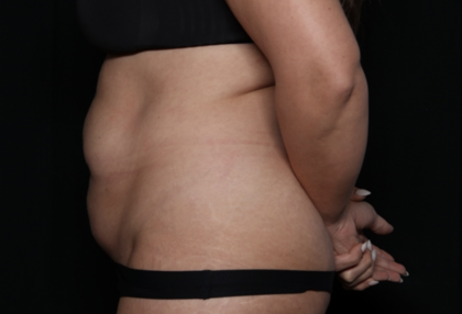 Tummy Tuck Before & After Patient #35884