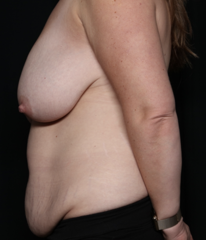Mommy Makeover Before & After Patient #35851