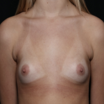 Breast Augmentation Before & After Patient #35852