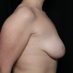 Breast Lift Before & After Patient #35853