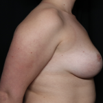 Breast Lift Before & After Patient #35853