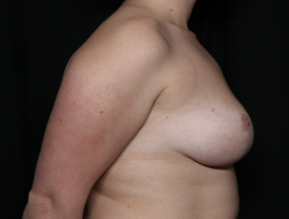 Breast Lift Before & After Patient #35853