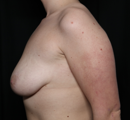 Breast Lift Before & After Patient #35853