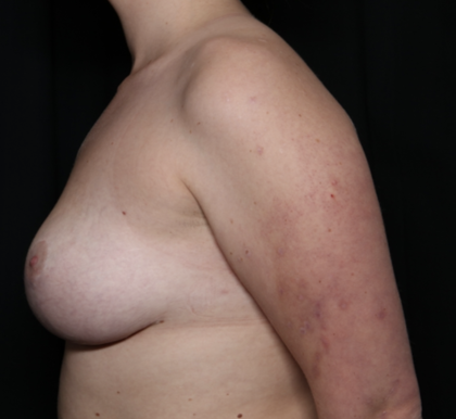 Breast Lift Before & After Patient #35853