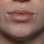Lip Filler Before & After Patient #35782