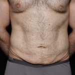 Tummy Tuck Before & After Patient #35790