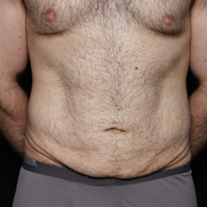 Tummy Tuck Before & After Patient #35790