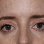 Upper Blepharoplasty Before & After Patient #35792