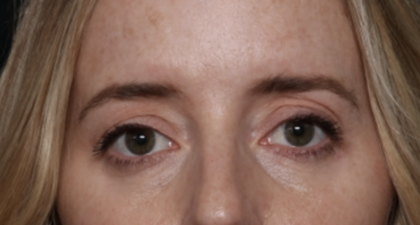 Upper Blepharoplasty Before & After Patient #35792