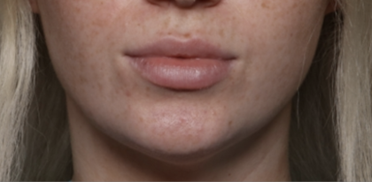 Lip Filler Before & After Patient #35782