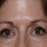 Lower Blepharoplasty Before & After Patient #35834