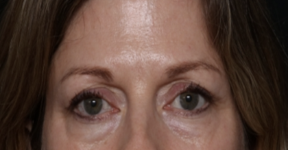 Lower Blepharoplasty Before & After Patient #35834