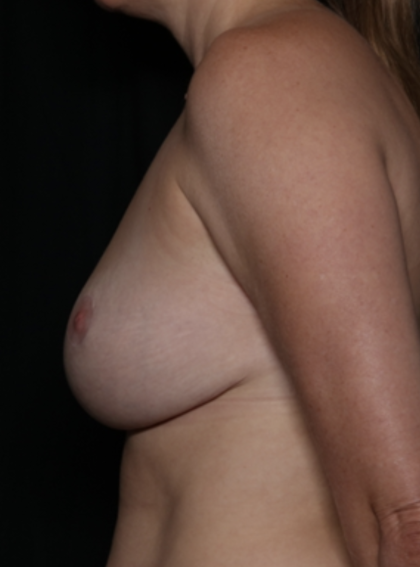 Breast Reduction Before & After Patient #35791