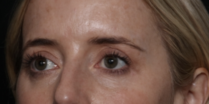 Upper Blepharoplasty Before & After Patient #35792