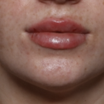 Lip Filler Before & After Patient #35782