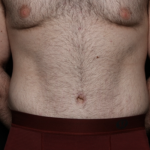 Tummy Tuck Before & After Patient #35790