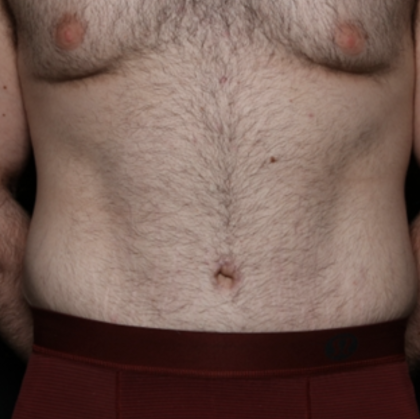 Tummy Tuck Before & After Patient #35790