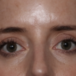 Upper Blepharoplasty Before & After Patient #35792