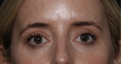 Upper Blepharoplasty Before & After Patient #35792