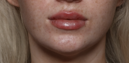 Lip Filler Before & After Patient #35782