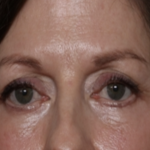 Lower Blepharoplasty Before & After Patient #35834