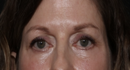 Lower Blepharoplasty Before & After Patient #35834