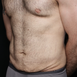 Tummy Tuck Before & After Patient #35790