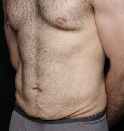 Tummy Tuck Before & After Patient #35790