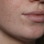 Lip Filler Before & After Patient #35782