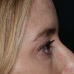 Upper Blepharoplasty Before & After Patient #35792